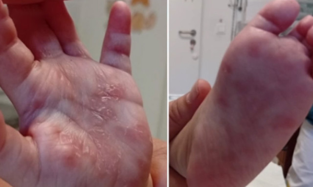 Kiskor&uacute; &eacute;s drogos anyuk&aacute;k: Borsodban h&aacute;rom csecsemő halt meg id&eacute;n velesz&uuml;letett szifiliszben