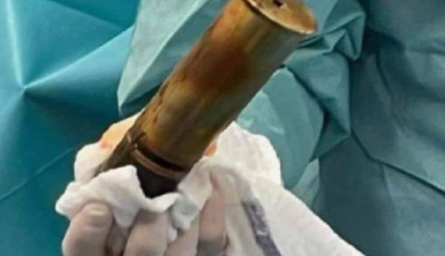 Első világháborús löveg szorult egy férfi ánuszába